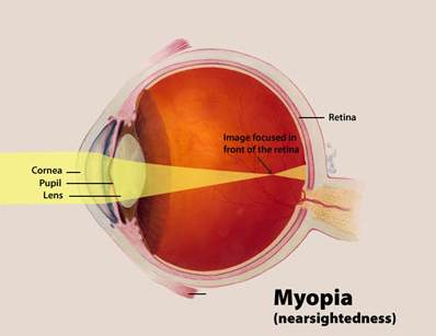 Retina Mata Lepas: Apa Itu Ablasio Retina, Gejala Awal, Pengobatan & Cara Mencegahnya